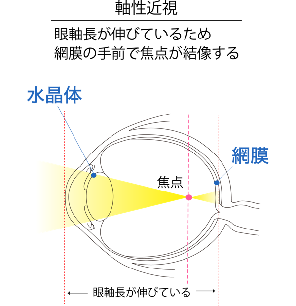 軸性近視